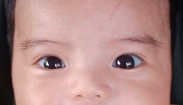 Kết mạc mắt màu xanh dương của bé - Ảnh: BS Úc Nguyễn