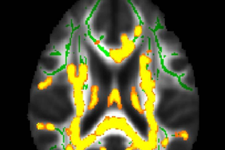 Hình ảnh cho thấy tình trạng viêm thần kinh gia tăng (màu vàng). Điều này có liên quan đến lượng mỡ ẩn (mỡ nội tạng) - Ảnh: RSNA