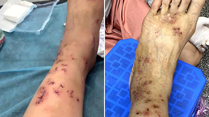 Hình ảnh chân của chị Thanh bị viêm mao mạch hoại tử - Ảnh: BNCC
