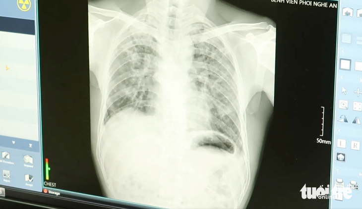 Phim chụp phổi của một công nhân nghi mắc bụi phổi - Ảnh: DOÃN HÒA