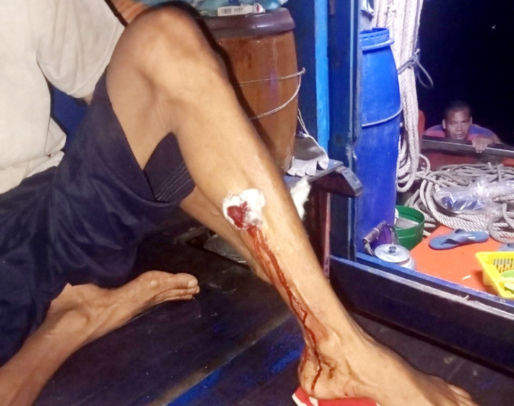 Một ngư dân bị đạn chì bắn trúng bắp chân - Ảnh: NVCC