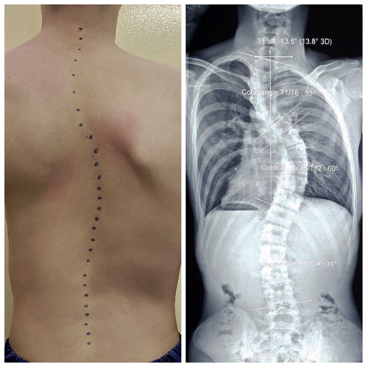 Hình ảnh X-quang cho thấy cột sống của một bạn trẻ bị vẹo hình chữ S rất nặng - Ảnh: Bác sĩ cung cấp