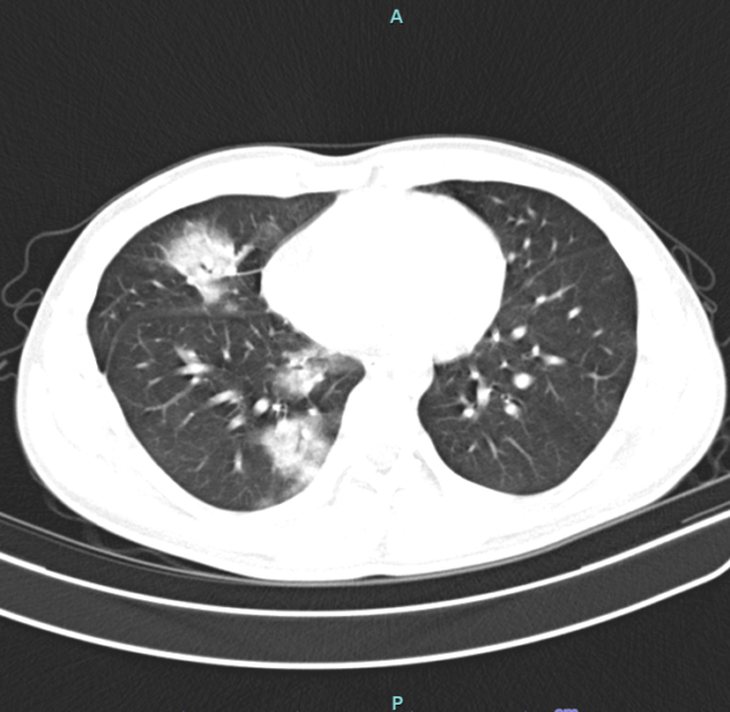 Phim chụp cắt lớp vi tính của người bệnh cho thấy tổn thương thâm nhiễm rộng thùy dưới phổi phải - Ảnh: BVCC