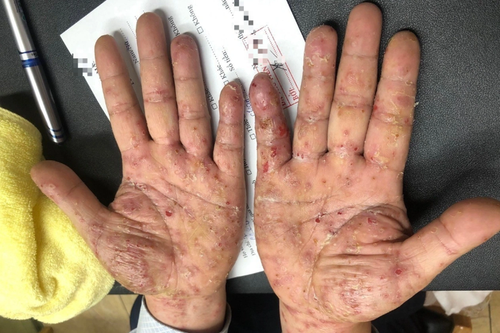 Tổn thương trên tay bệnh nhân - Ảnh: BSCC