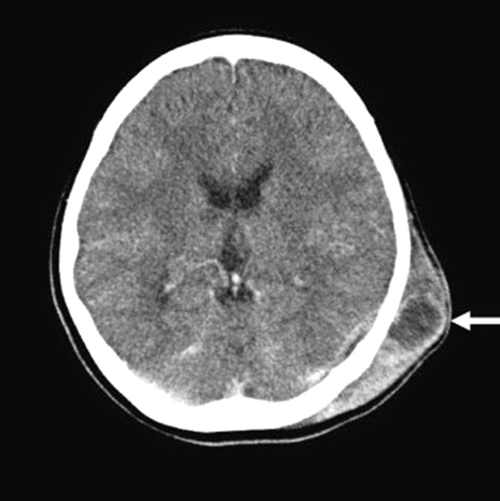 Hình CT áp xe da đầu - Ảnh: SCIENCE DIRECT