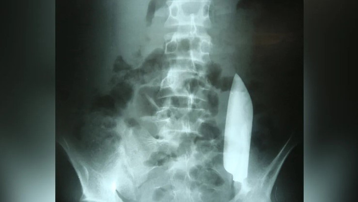 Kết quả chụp X-quang cho thấy lưỡi dao đã di chuyển từ bên phải sang bên trái bụng của một người đàn ông - Ảnh: LIVE SCIENCE