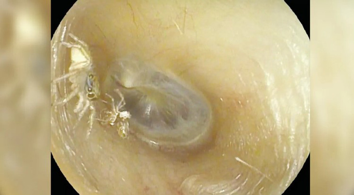 Đây là con nhện sống trong ống tai trái của người phụ nữ, bên cạnh vỏ ngoài của nó.- Ảnh: THE NEW ENGLAND JOURNAL OF MEDICINE.