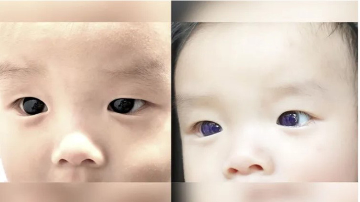 Đôi mắt nâu sẫm thường ngày của cậu bé (trái) chuyển sang màu chàm (phải) - Ảnh: LIVE SCIENCE