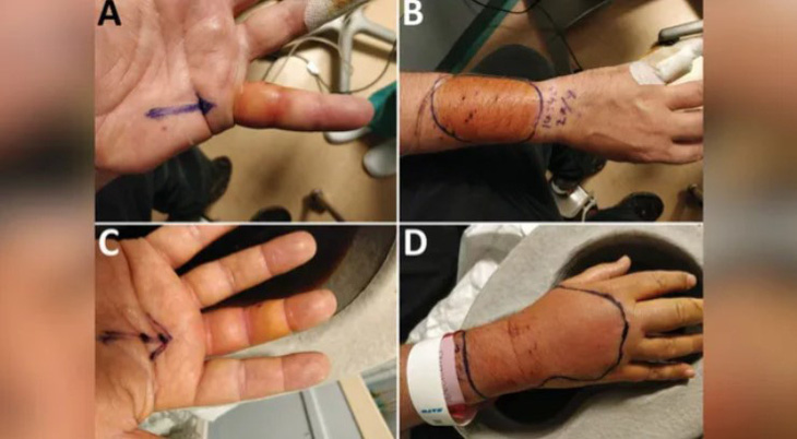 Nhiễm trùng đau đớn ở bàn tay và cánh tay của một người đàn ông hóa ra là do một loài vi khuẩn chưa được biết đến trước đây - Ảnh: LIVE SCIENCE