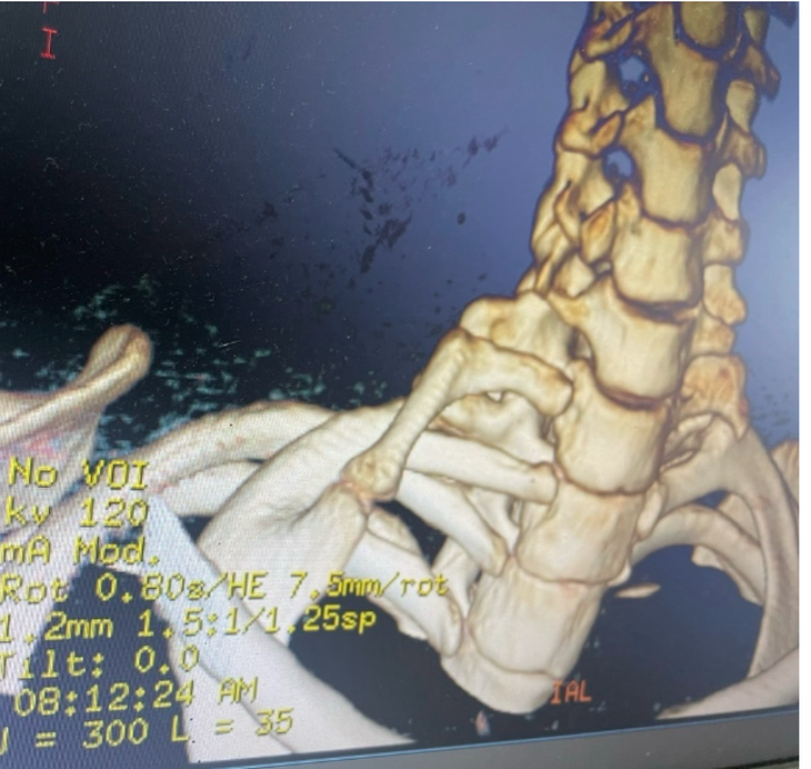 Hình ảnh khối xương bất thường của bệnh nhân Vi Thị Th. - Ảnh: BSCC