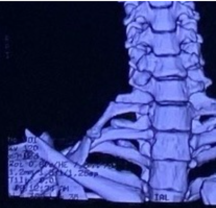 Khối xương bất thường của bệnh nhân trên phim chụp - Ảnh BSCC