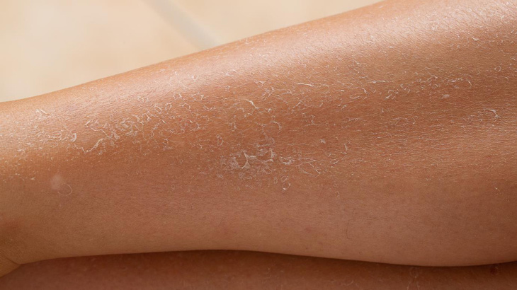 Khô da không đơn thuần chỉ là biểu hiện sức khỏe của da