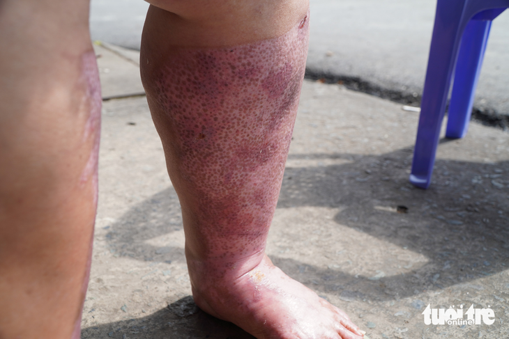 Người phụ nữ bị ném bom xăng lột trụi da chân, hơn cả tháng công an chưa vào cuộc - Ảnh 2.