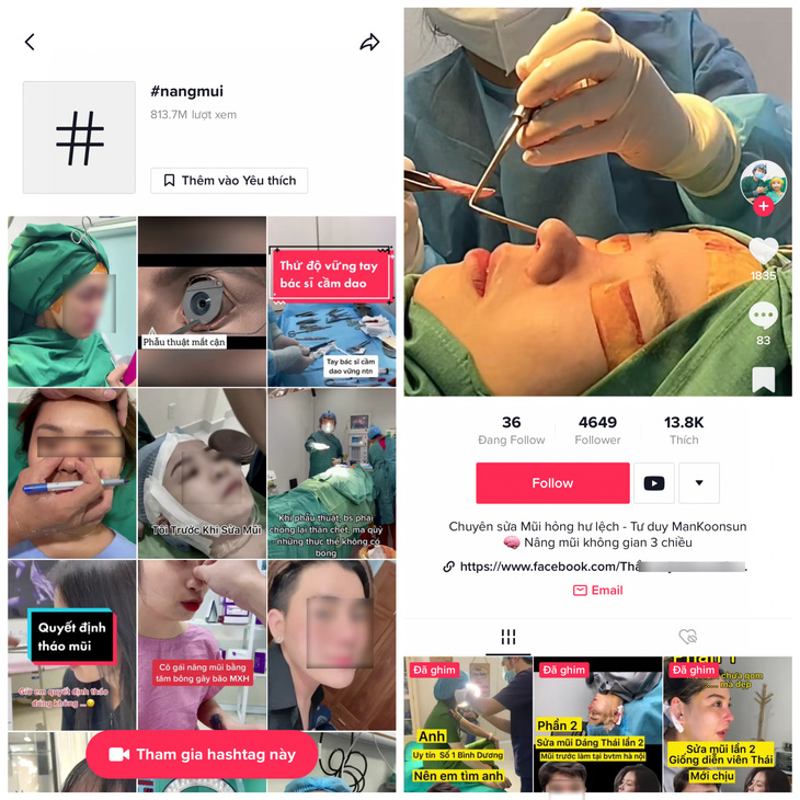 "Bác sĩ" mạng "hướng dẫn" phẫu thuật nâng mũi trên TikTok - Ảnh: Chụp màn hình