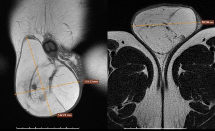 Hình ảnh chụp khối u tại vùng bìu bệnh nhân - Ảnh: BVCC