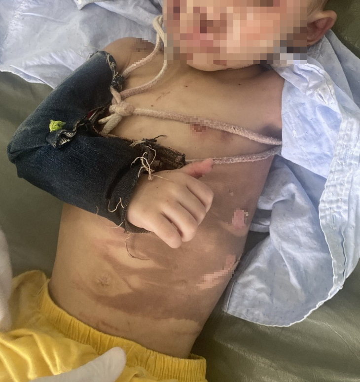 Bé trai 2 tuổi lúc mới nhập viện - Ảnh: Bác sĩ cung cấp