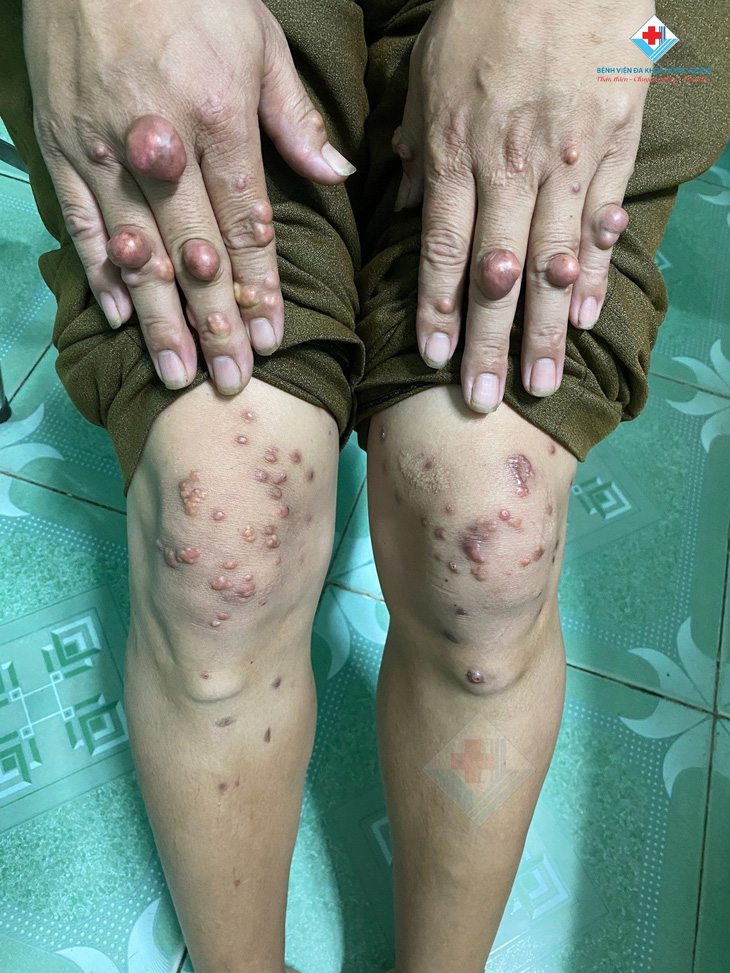 Bệnh nhân bị u cục tay chân trong nhiều năm - Ảnh: BVCC