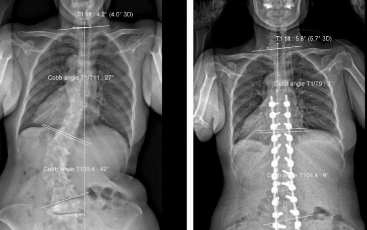 Cao thêm 8cm, dáng đi thẳng sau nhiều năm vẹo cột sống thắt lưng