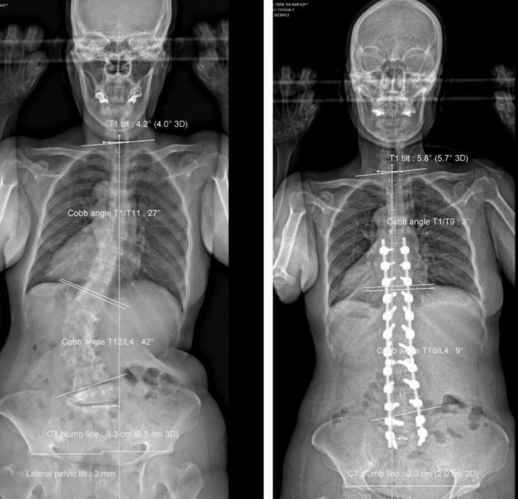 Hình ảnh trước và sau khi phẫu thuật của bệnh nhân 60 tuổi bị vẹo cột sống thắt lưng sang phải - Ảnh: Bác sĩ cung cấp