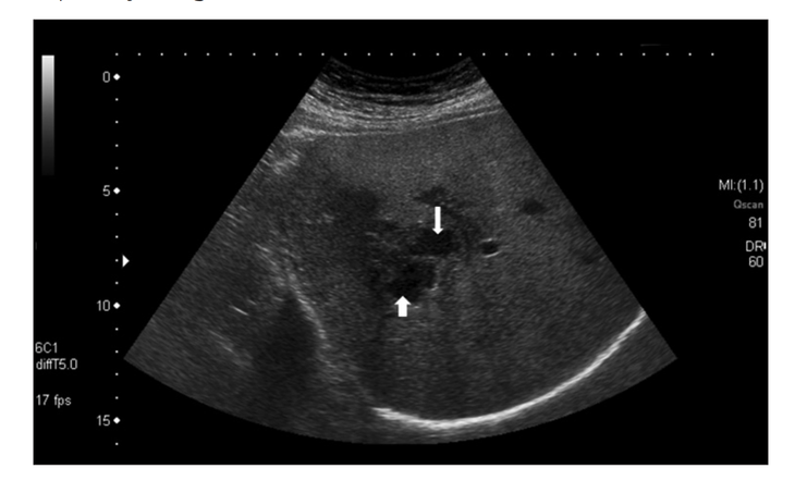 Trong 3 tháng, 172 bệnh nhân áp xe gan vô Bệnh viện Bệnh nhiệt đới, tất cả đều từ rau sống - Ảnh 2.