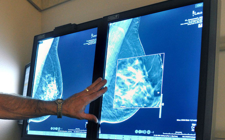 Vì sao Mỹ khuyến nghị phụ nữ tầm soát ung thư vú định kỳ từ 40 tuổi?