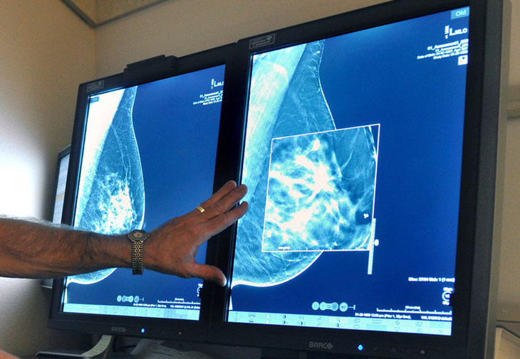 Vì sao Mỹ khuyến nghị phụ nữ tầm soát ung thư vú định kỳ từ 40 tuổi? - Ảnh 1.