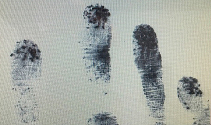 Dấu vân tay của người mắc chứng bệnh không có dấu vân tay (adermatoglyphia) - Ảnh: onlinelibrary.wiley.com