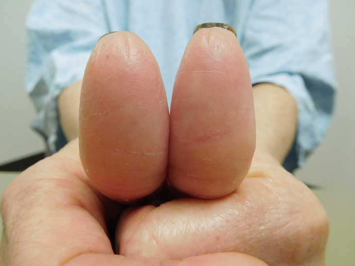 Đầu ngón tay phẳng lì của một phụ nữ dùng thuốc điều trị ung thư vú - Ảnh: cureus.com