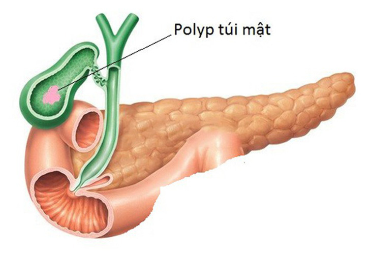 Polyp túi mật - Ảnh minh họa