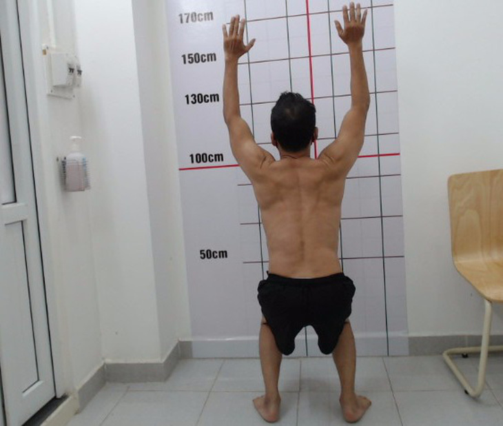 Một bệnh nhân bị mất đường cong sinh lý cột sống ngực và thắt lưng vì tập gym sai cách - Ảnh: Bác sĩ cung cấp