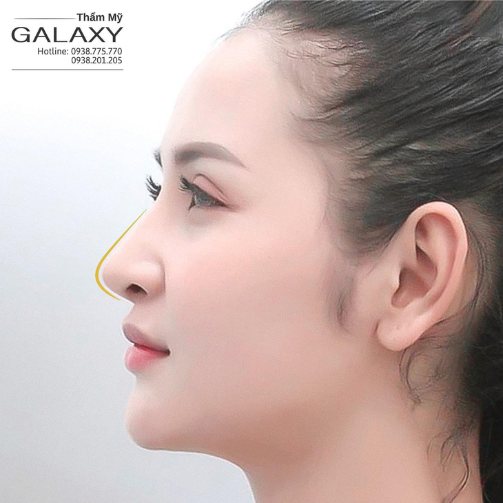 Nâng mũi đẹp hài hòa tại thẩm mỹ Galaxy - Ảnh 2.