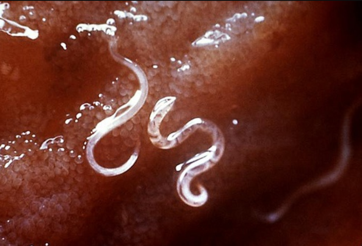 Không tẩy giun nhiều năm, ấu trùng giun di trú qua phổi - Ảnh 1.