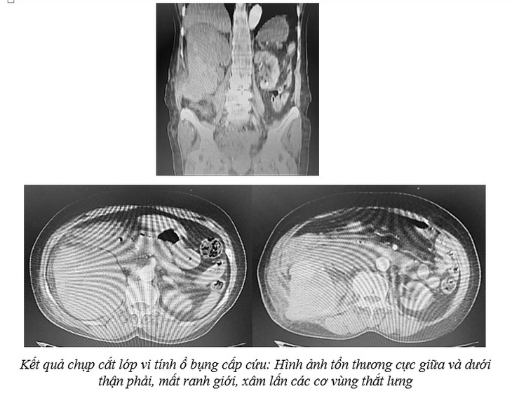 Không có dấu hiệu mà sốc mất máu do vỡ khối u thận - Ảnh 2.