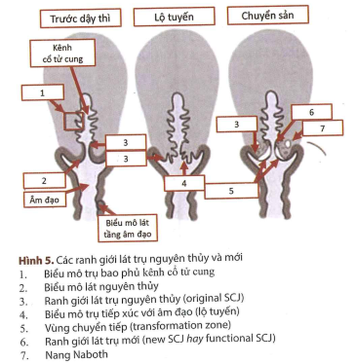 Chưa quan hệ tình dục đã viêm lộ tuyến cổ tử cung, vì sao? - Ảnh 2.