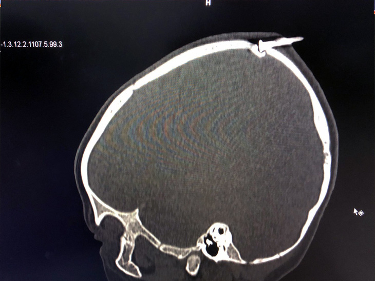 Cây đinh sắt đâm vào đỉnh đầu bé trai 2 tuổi làm lún xương sọ - Ảnh: Bệnh viện cung cấp