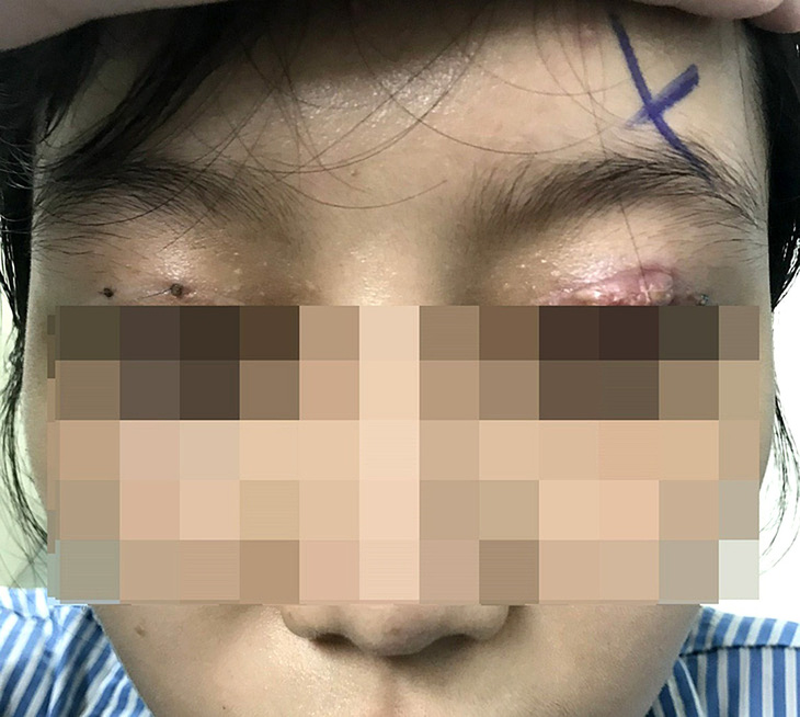 Một nữ bệnh nhân phải nhập viện điều trị vì bị tổn thương mắt sau khi làm đẹp tại cơ sở thẩm mỹ chui - Ảnh: Bệnh viện cung cấp