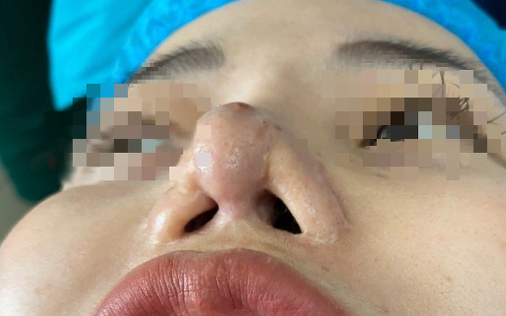 Nữ chủ spa bị biến dạng mũi sau 9 lần ‘sửa chữa’