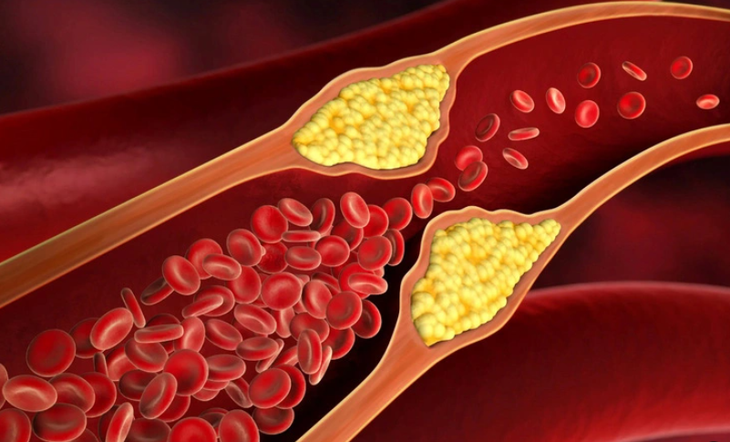 Cholesterol máu tăng cao gây xơ vữa động mạch - Ảnh minh họa
