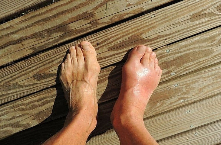 Triệu chứng của bệnh gout cấp là sưng đau, nóng đỏ thường ở bàn chân hoặc ngón chân cái - Ảnh: Awakening State