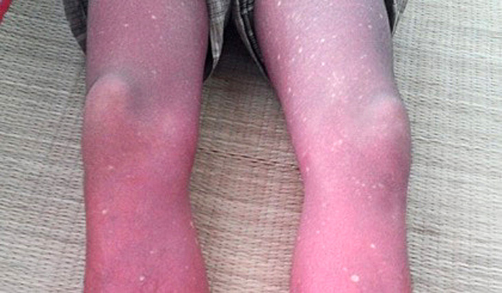 Ban phục hồi trên chân bé bị bệnh sốt xuất huyết - Ảnh: BS Úc Nguyễn