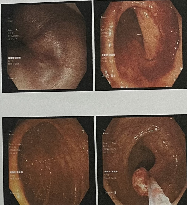 Hình ảnh nội soi đại tràng - trực tràng bệnh nhi tại Bệnh viện Nhi đồng Cần Thơ - Ảnh: BV cung cấp
