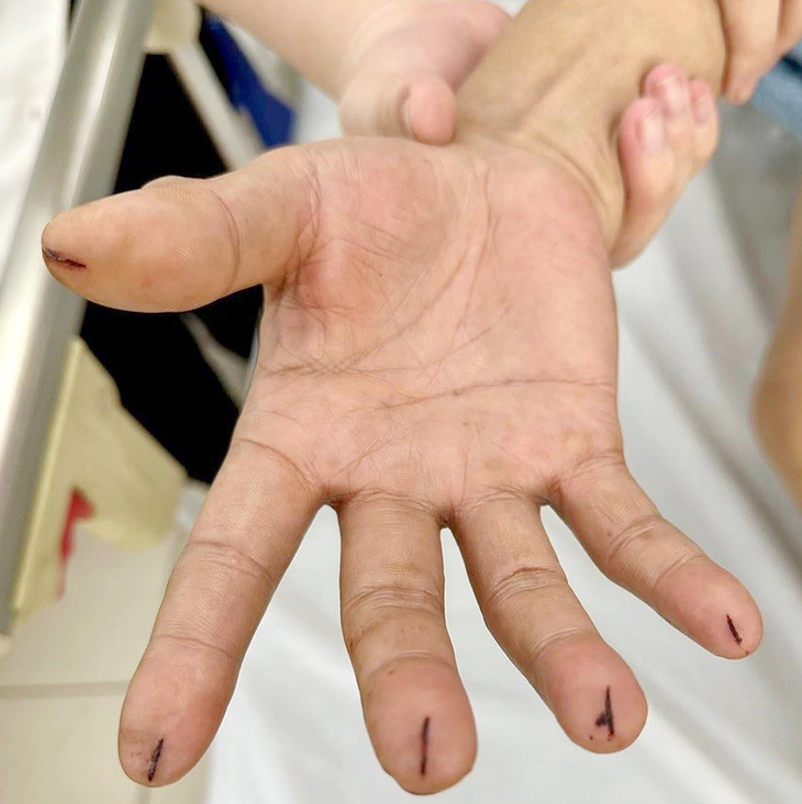 Bệnh nhân rạch đầu ngón tay để chữa đột quỵ gây nguy hiểm - Ảnh: BVCC