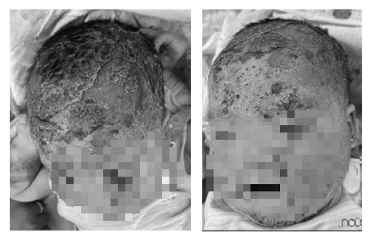 Trẻ nhập viện trong tình trạng bong tróc vùng da đầu - Ảnh: Bệnh viện cung cấp