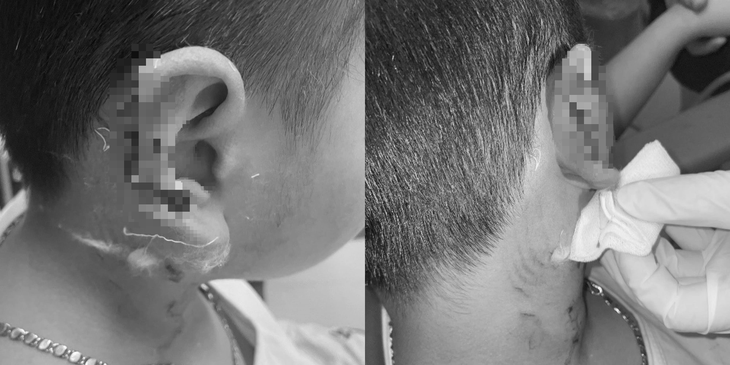 Bé trai bị chó Phú Quốc cào gây biến dạng vành tai - Ảnh: Bệnh viện cung cấp