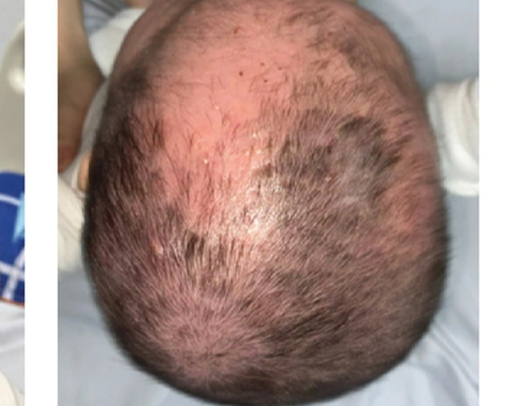 Sau 4 ngày điều trị, tình trạng da đầu trẻ đã được cải thiện - Ảnh: Bệnh viện cung cấp