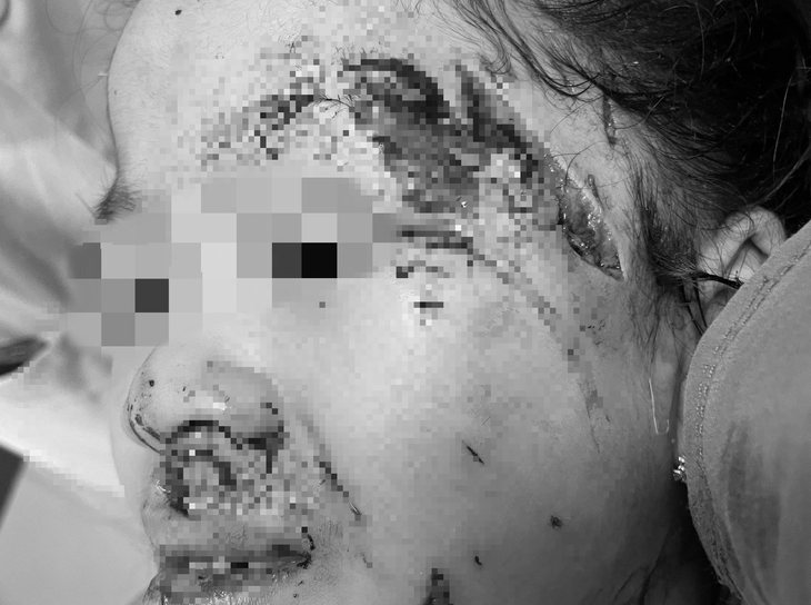 Bé L. bị chó cắn gây chấn thương nặng vùng mặt - Ảnh: Bệnh viện cung cấp