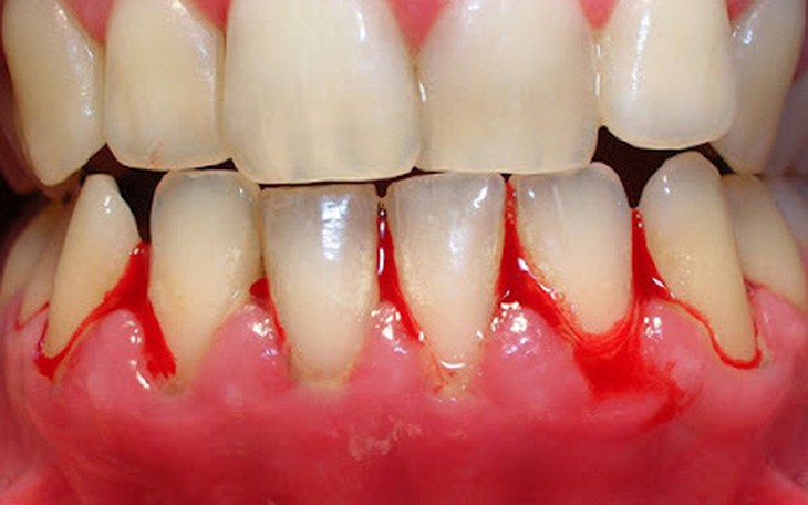 Máu chảy không ngừng sau khi lấy cao răng, bất ngờ phát hiện mắc ung thư máu