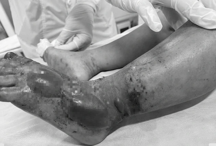 Bàn chân bệnh nhi tím đen sau khi bị rắn hổ mang cắn - Ảnh: Bệnh viện cung cấp