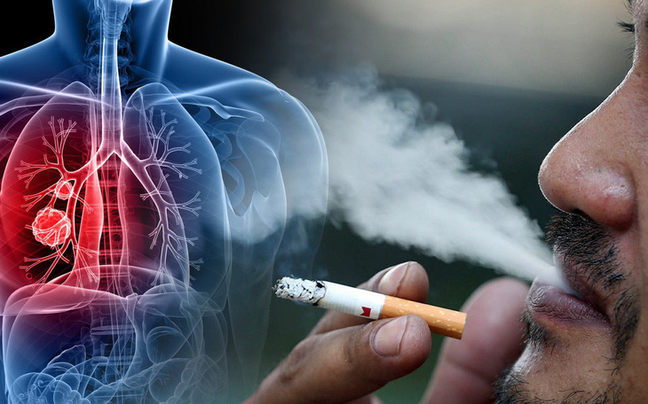 Tầm soát ung thư phổi tăng cơ hội sống cho bệnh nhân ở Việt Nam