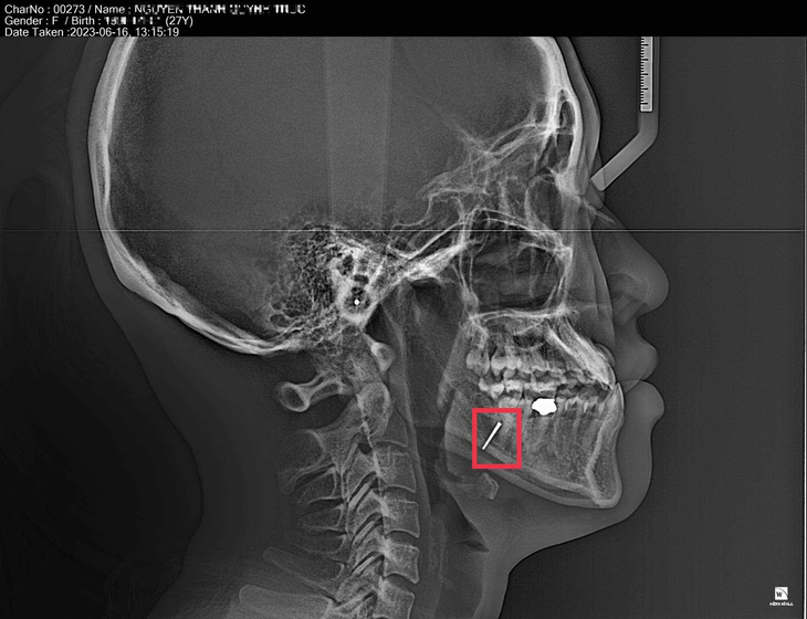 Hình ảnh mũi khoan bị &quot;để quên&quot; khi nhổ răng khôn còn trên hàm của bệnh nhân khi chụp X-quang - Ảnh: Bệnh nhân T. cung cấp